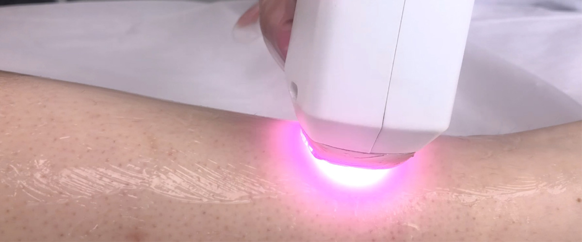 at home laser hair removal